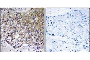 Immunohistochemistry analysis of paraffin-embedded human breast carcinoma tissue, using ATG4A Antibody. (ATG4A anticorps  (AA 81-130))