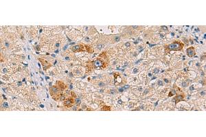 Immunohistochemistry of paraffin-embedded Human liver cancer tissue using RMDN2 Polyclonal Antibody at dilution of 1:50(x200) (FAM82A1 anticorps)