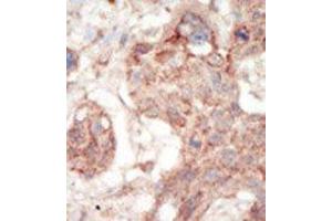Formalin-fixed and paraffin-embedded human cancer tissue reacted with the primary antibody, which was peroxidase-conjugated to the secondary antibody, followed by AEC staining.