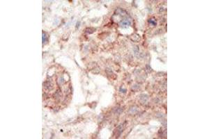 Formalin-fixed and paraffin-embedded human cancer tissue reacted with the primary antibody, which was peroxidase-conjugated to the secondary antibody, followed by AEC staining. (FLT3 anticorps  (C-Term))