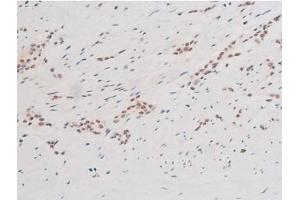 ABIN6267523 at 1/200 staining Human bladder cancer tissue sections by IHC-P.
