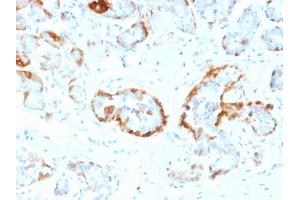 Formalin-fixed, paraffin-embedded human Breast stained with Crystallin Alpha B Mouse Monoclonal Antibody (CPTC-CYRAB-1).