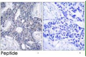 Immunohistochemical analysis of paraffin-embedded human breast carcinoma tissue using ZAP70 polyclonal antibody  . (ZAP70 anticorps)