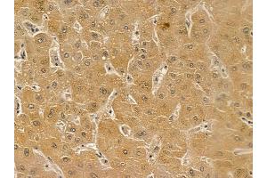 Estrogen-induced gene 121 protein Mouse Monoclonal Antibody at 1/100 staining human liver cancer by IHC-P.