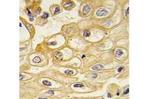 IHC testing of FFPE human lung carcinoma with ROR1 antibody.