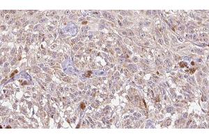 ABIN6268692 at 1/100 staining Human Melanoma tissue by IHC-P.