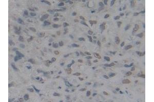 Detection of HMGB1 in Human Lung cancer Tissue using Polyclonal Antibody to High Mobility Group Protein 1 (HMGB1) (HMGB1 anticorps  (AA 9-163))