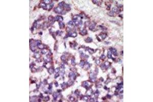 Formalin-fixed and paraffin-embedded human cancer tissue reacted with the primary antibody, which was peroxidase-conjugated to the secondary antibody, followed by AEC staining.