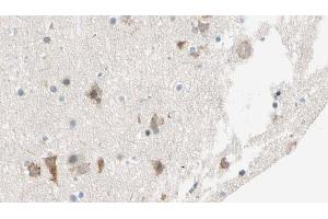 ABIN6274542 at 1/100 staining Human brain cancer tissue by IHC-P. (SHPK anticorps  (N-Term))