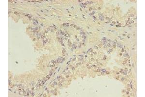 Immunohistochemistry of paraffin-embedded human prostate cancer using ABIN7147411 at dilution of 1:100