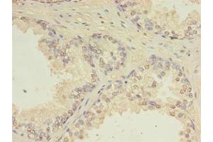 Immunohistochemistry of paraffin-embedded human prostate cancer using ABIN7147411 at dilution of 1:100 (CEP63 anticorps  (AA 1-495))