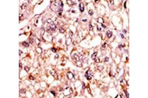 IHC analysis of FFPE human hepatocarcinoma tissue stained with the phospho-p53 antibody