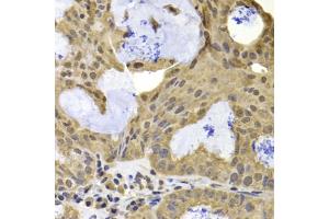 Immunohistochemistry of paraffin-embedded human oophoroma using TERF2IP antibody (ABIN5975683) at dilution of 1/100 (40x lens). (RAP1 anticorps)