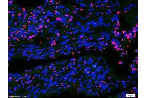 Formalin-fixed and paraffin-embedded human colon carcinoma labeled with Anti-DATF1/IDO1 Polyclonal Antibody, Unconjugatedused at 1:200 dilution for 40 minutes at 37°C.