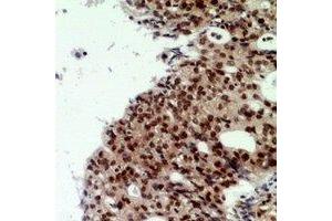 Immunohistochemical analysis of CNOT7 staining in human ovarian cancer formalin fixed paraffin embedded tissue section. (CNOT7 anticorps  (N-Term))