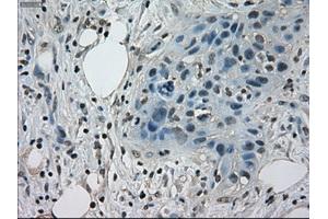 Immunohistochemical staining of paraffin-embedded Adenocarcinoma of colon tissue using anti-STAT1mouse monoclonal antibody. (STAT1 anticorps)