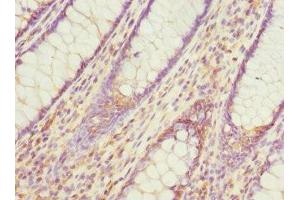 Immunohistochemistry of paraffin-embedded human colon cancer using ABIN7164695 at dilution of 1:100 (PDCD5 anticorps  (AA 1-125))