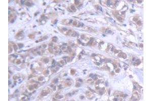 DAB staining on IHC-P; Samples: Human Breast cancer Tissue