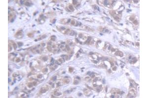 DAB staining on IHC-P; Samples: Human Breast cancer Tissue (ABCB6 anticorps  (AA 590-842))