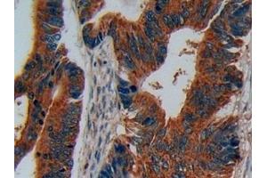 Detection of DISC1 in Human Colorectal cancer Tissue using Polyclonal Antibody to Disrupted In Schizophrenia 1 (DISC1) (DISC1 anticorps  (AA 102-261))