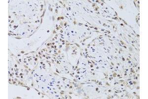 Immunohistochemistry of paraffin-embedded human gastric cancer using FKBP4 Antibody.