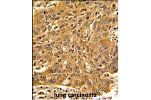 Formalin-fixed and paraffin-embedded human lung carcinoma with Fascin Antibody (Center), which was peroxidase-conjugated to the secondary antibody, followed by DAB staining. (Fascin anticorps  (AA 322-350))