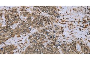 Immunohistochemistry of paraffin-embedded Human cervical cancer tissue using DCTN4 Polyclonal Antibody at dilution 1:50 (Dynactin 4 anticorps)