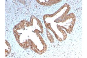 Formalin-fixed, paraffin-embedded human Prostate Carcinoma stained with COX-2 Recombinant Rabbit Monoclonal Antibody (COX2/3232R). (Recombinant PTGS2 anticorps  (AA 442-572))