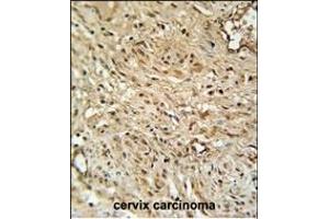 R Antibody (C-term) (ABIN651453 and ABIN2840247) immunohistochemistry analysis in formalin fixed and paraffin embedded human cervix carcinoma followed by peroxidase conjugation of the secondary antibody and DAB staining. (TWIST Neighbor anticorps  (C-Term))