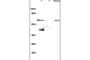 Formalin-fixed and paraffin embedded human gastric carcinoma labeled with Rabbit Anti ApoA4 Polyclonal Antibody, Unconjugated (ABIN749153) at 1:200 followed by conjugation to the secondary antibody and DAB staining