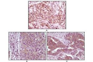 Immunohistochemical analysis of paraffin-embedded human pancreas carcinoma (A), esophagus carcinoma tissue (B) and ovary tumor tissue, showing cytoplasmic and membrane localization using 4E-BP1 antibody with DAB staining. (eIF4EBP1 anticorps)