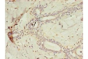 Immunohistochemistry of paraffin-embedded human breast cancer using ABIN7158845 at dilution of 1:100 (m-AAA Protease-Interacting Protein 1, Mitochondrial (MAIP1) (AA 97-291) anticorps)