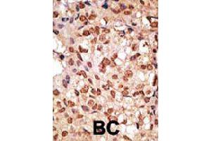 Formalin-fixed and paraffin-embedded human cancer tissue reacted with SIGLEC7 polyclonal antibody  , which was peroxidase-conjugated to the secondary antibody, followed by DAB staining.