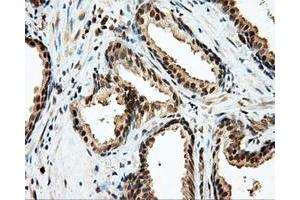 Immunohistochemical staining of paraffin-embedded Carcinoma of liver tissue using anti-LIPG mouse monoclonal antibody. (LIPG anticorps)