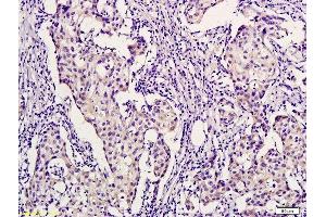 Formalin-fixed and paraffin embedded human breast cancer labeled with Anti-PHYH Polyclonal Antibody, Unconjugated  followed by conjugation to the secondary antibody and DAB staining