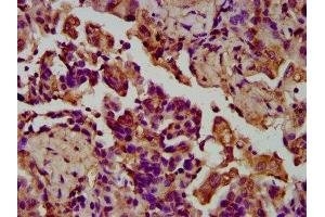 IHC image of ABIN7158078 diluted at 1:200 and staining in paraffin-embedded human lung cancer performed on a Leica BondTM system. (LGI4 anticorps  (AA 292-412))