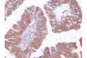 IHC-P analysis of Human Liver Cancer Tissue, with DAB staining. (GOT1 anticorps  (AA 1-413))