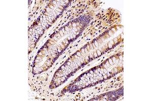 Immunohistochemistry analysis of paraffin embedded human colon using MTHFD1 (ABIN7074609) at dilution of 1: 700 (MTHFD1 anticorps)