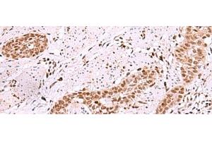 Immunohistochemistry of paraffin-embedded Human esophagus cancer tissue using ISL2 Polyclonal Antibody at dilution of 1:40(x200) (ISL2 anticorps)