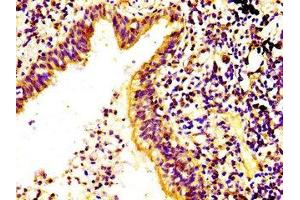 IHC image of ABIN7168192 diluted at 1:400 and staining in paraffin-embedded human lung cancer performed on a Leica BondTM system. (RPS6KA6 anticorps  (AA 340-467))
