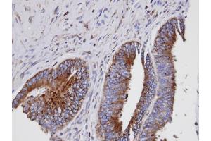 IHC-P Image Immunohistochemical analysis of paraffin-embedded human mixed ovarian cancer, using GIT1, antibody at 1:100 dilution. (GIT1 anticorps  (Internal Region))