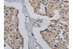 The image on the left is immunohistochemistry of paraffin-embedded Human prostate cancer tissue using ABIN7191867(PHKG1 Antibody) at dilution 1/20, on the right is treated with synthetic peptide. (PHKG1 anticorps)