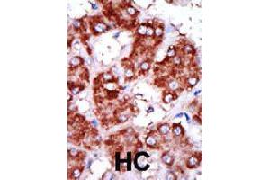 Formalin-fixed and paraffin-embedded human hepatocellular carcinoma tissue reacted with CPT1B polyclonal antibody  , which was peroxidase-conjugated to the secondary antibody, followed by DAB staining . (CPT1B anticorps  (C-Term))