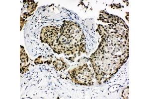 IHC-P: HOXA4 antibody testing of human breast cancer tissue (HOXA4 anticorps  (N-Term))
