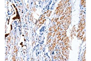 The image on the left is immunohistochemistry of paraffin-embedded Human prostate cancer tissue using ABIN7128792(CATSPER1 Antibody) at dilution 1/40, on the right is treated with fusion protein. (CATSPER1 anticorps)
