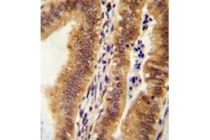 Immunohistochemistry analysis in formalin fixed and paraffin embedded human uterus tissue reacted with KIAA1609 Antibody (C-term) followed which was peroxidase conjugated to the secondary antibody and followed by AB staining. (KIAA1609 anticorps  (C-Term))