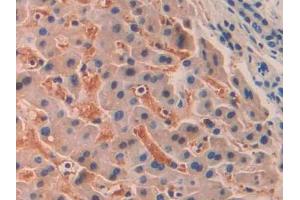 IHC-P analysis of Human Liver cancer Tissue, with DAB staining. (SIGLEC12 anticorps  (AA 22-218))