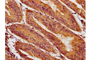 IHC image of ABIN7156016 diluted at 1:400 and staining in paraffin-embedded human endometrial cancer performed on a Leica BondTM system.