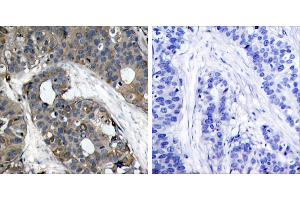 Peptide - +Immunohistochemical analysis of paraffin-embedded human breast carcinoma tissue using HSP27 (Ab-82) (Ab-232) antibody (#B7112). (HSP27 anticorps  (pSer82))