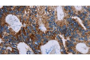 Immunohistochemistry of paraffin-embedded Human colon cancer using JAM-A Polyclonal Antibody at dilution of 1:40 (F11R anticorps)